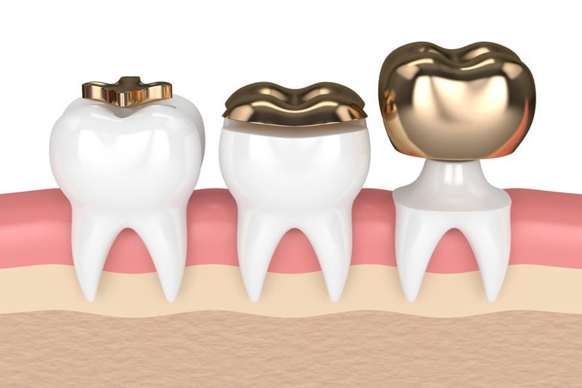 what you should know about dental inlays and onlays